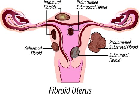 Fibroid Pictures
